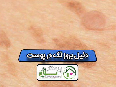 دلیل بروز لک در پوست